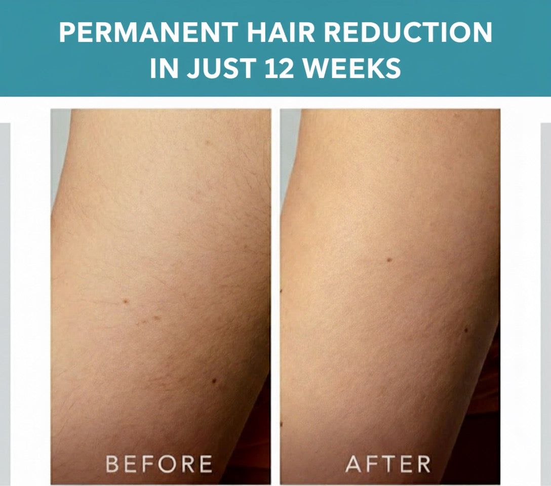 FOREO Peach 2 go IPL Hair Removal Device